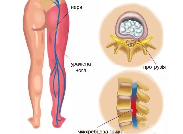 Ішіас: чому болить нога, що робити і коли це невідкладний стан