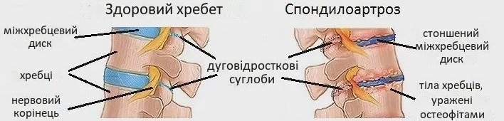 Який лікар лікує спондилоартроз дуговідросткових суглобів?