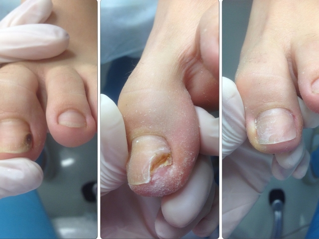Оніхолізисом нігтів: що це таке і як це лікувати? Правила протезування нігтів на онихолизисе. Огляд засобів для протезування нігтів при травматичном онихолизисе. Оніхолізисом &#8212; це грибок?