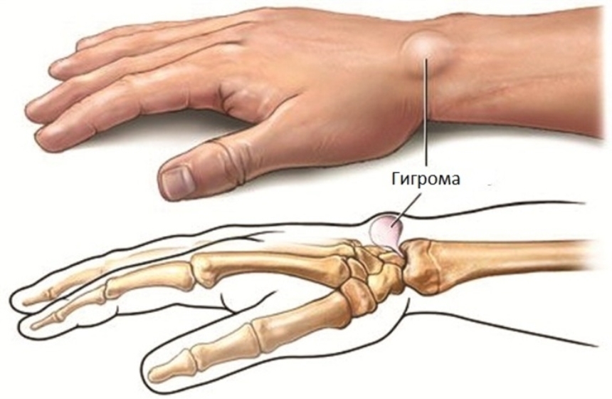 Симптоми гігроми на руці