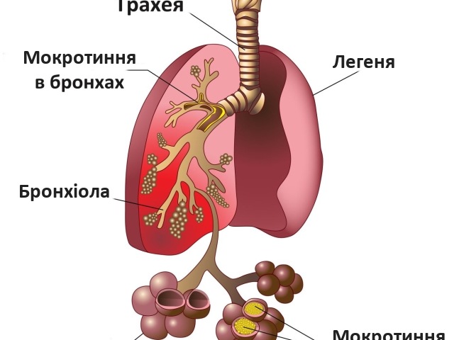 Пневмонія у дорослих, дітей, новонароджених: види, ознаки, симптоми, причини, збудники, шляхи зараження, ускладнення, діагностика, аналіз крові, мокротиння, рентген, лікування, антибіотики, наслідки, реабілітація, дихальні вправи. Скільки ле