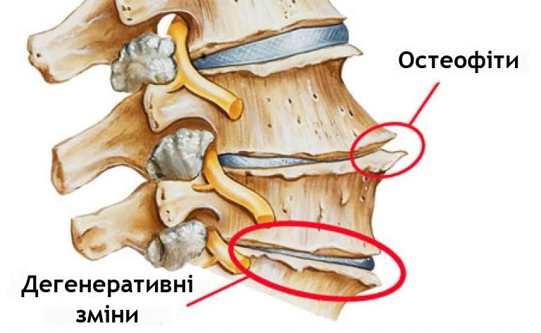 Деформуючий, анкілозуючий, помірний спондилоартроз