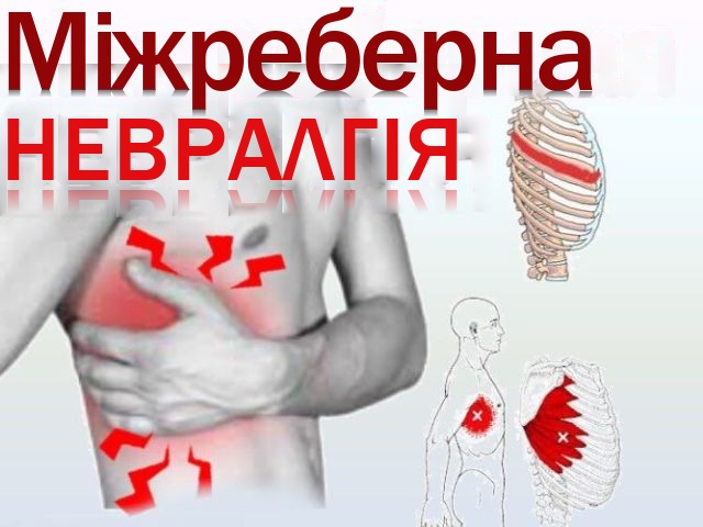 Міжреберна невралгія: ознаки, симптоми, лікування, профілактика