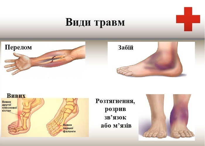 Забій, перелом чи тріщина: ознаки й коли звертатися до лікаря
