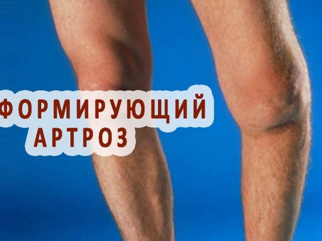 Деформуючий артроз колінного суглоба: симптоми, причини, методи медикаментозного лікування. Що таке деформуючий артроз колінного суглоба?