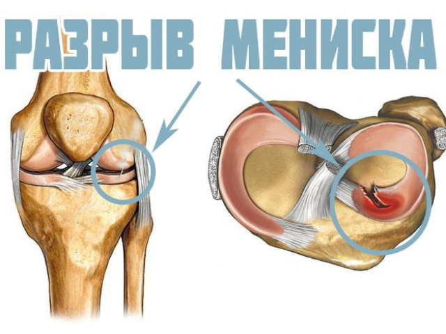 Що таке меніск колінного суглоба? Розрив меніска колінного суглоба: причини, симптоми, лікування
