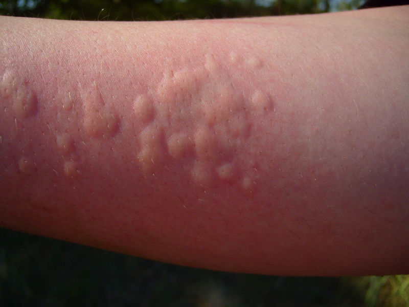 Аналіз на всі види алергії: причини та методи діагностики