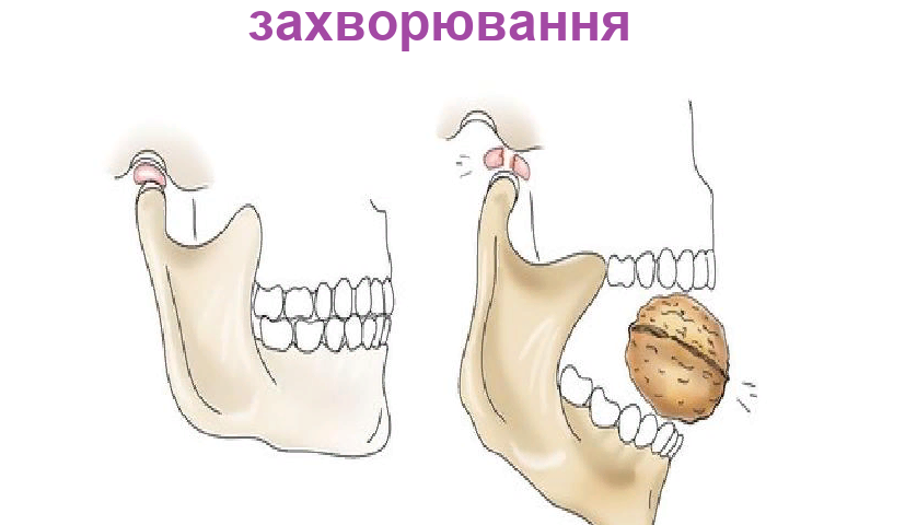 Скронево-нижньощелепний суглоб: будова, анатомію, кровопостачання, іннервація, рухи, м'язи, кістки, суглобові поверхні, диск, капсула, класифікація, функціональні особливості, характеристика. Захворювання СНЩС, види діагностики: больовий синдром дис